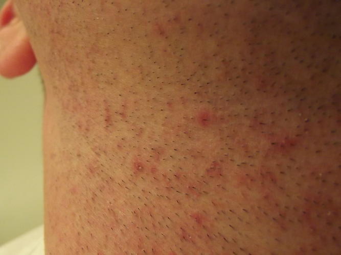 bumpy rash on neck