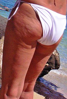 Name:  230px-Dimpled_appearance_of_cellulite-1.jpg
Views: 170
Size:  22.6 KB