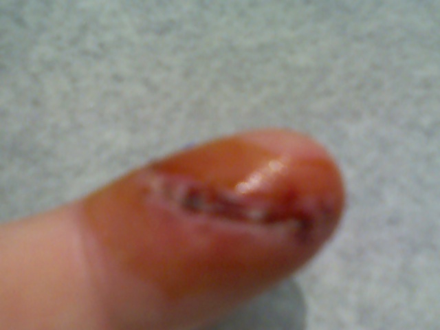 Name:  stitches out.jpg
Views: 4476
Size:  56.6 KB